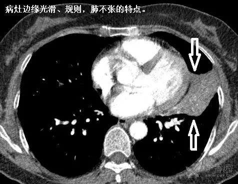 轻松搞定肺不张,肺ct入门难点之一 | 趣读ct