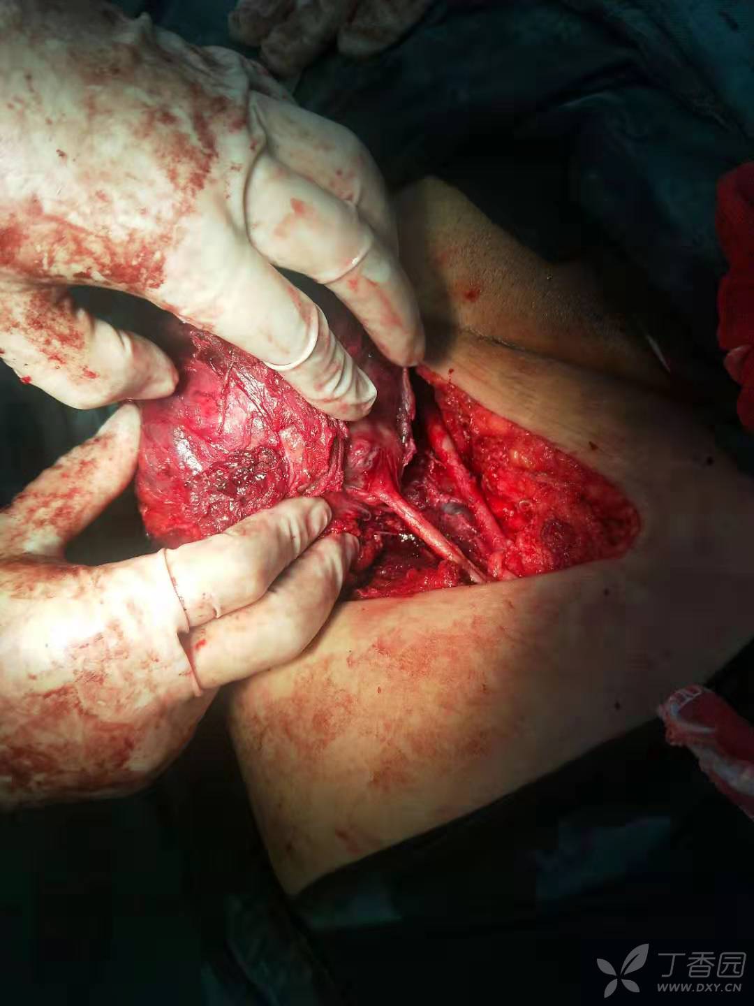 大腿股神经起源的肿瘤 [病例帖]