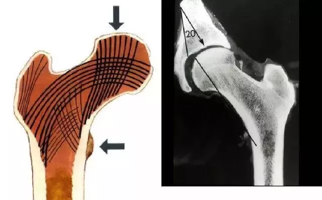 股骨颈内骨小梁走形