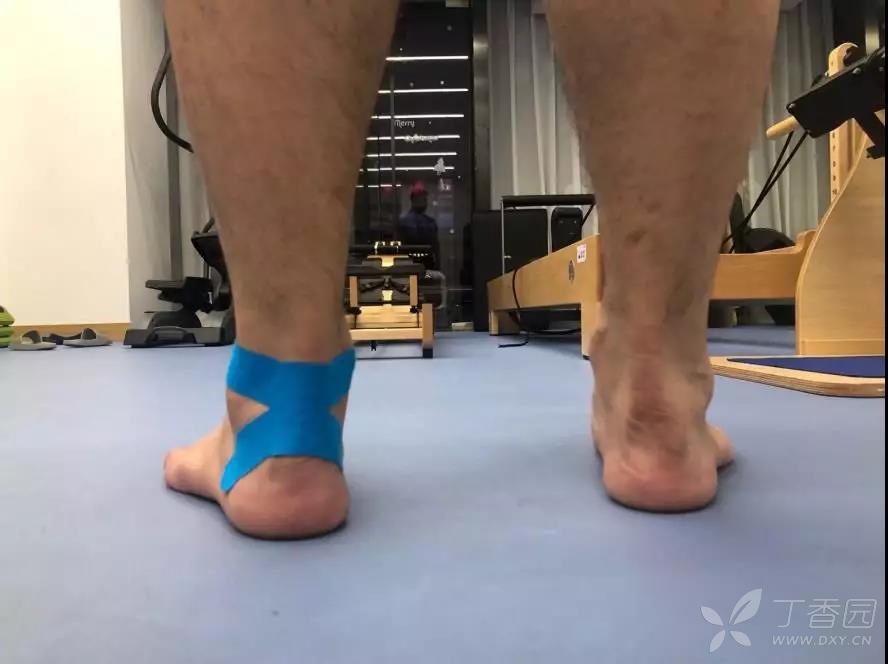 跟腱疼痛≠跟腱炎!你最想知道答案的五个"跟腱病"问题