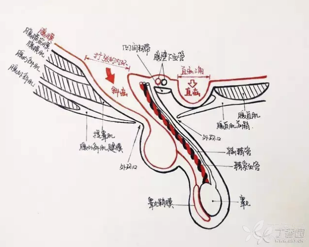 腹股沟直疝与斜疝的区别 对照此图再读一遍,是否不需再死记硬背?