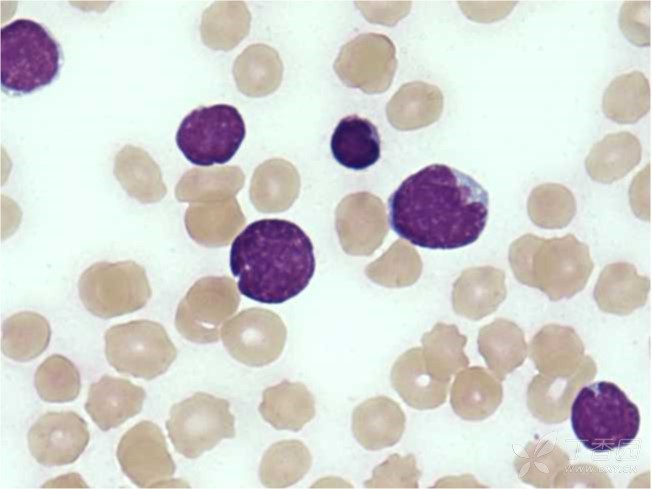异型淋巴细胞和异常淋巴细胞