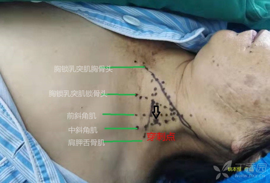 肌间沟臂丛加颈浅麻醉行锁骨中段骨折内固定术实操视频