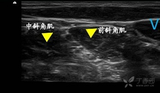 肌间沟臂丛加颈浅麻醉行锁骨中段骨折内固定术实操视频