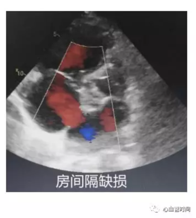 心脏超声:10 大切面,一文搞定!