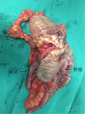 帖子详情2,此次切除阑尾最大的顾虑是回盲部有其他病变,切除阑尾后