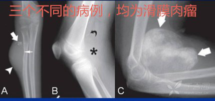 邻近骨质可破坏.