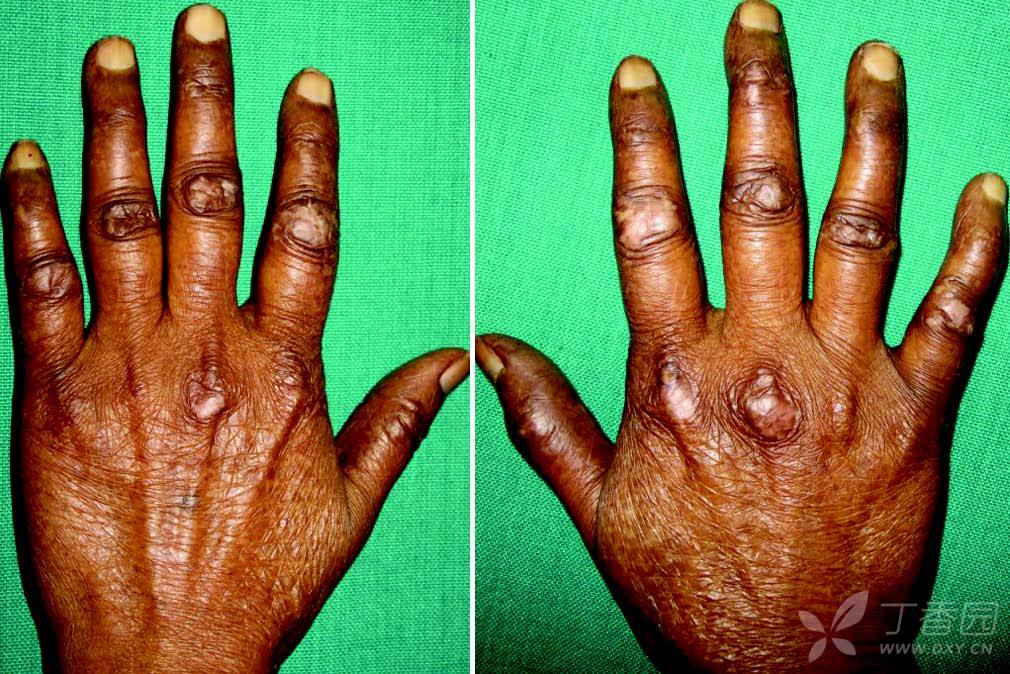 gottron papules and gottron sign : a pathognomonic sign of