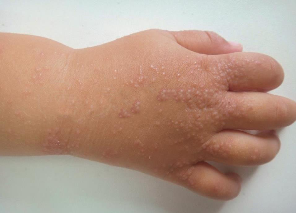 皮损特征:典型皮损为手背或手腕小丘疹,形态单一,对称,可散