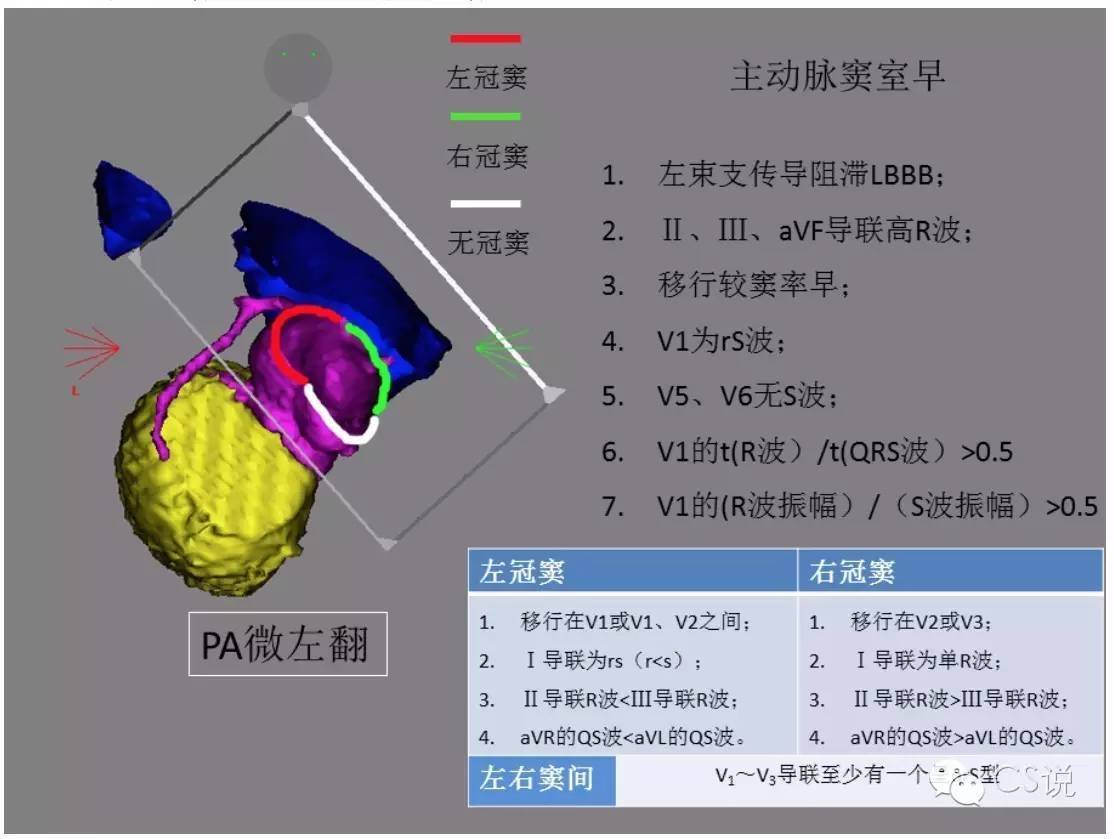 右室流出道室早定位总结(图文并茂)