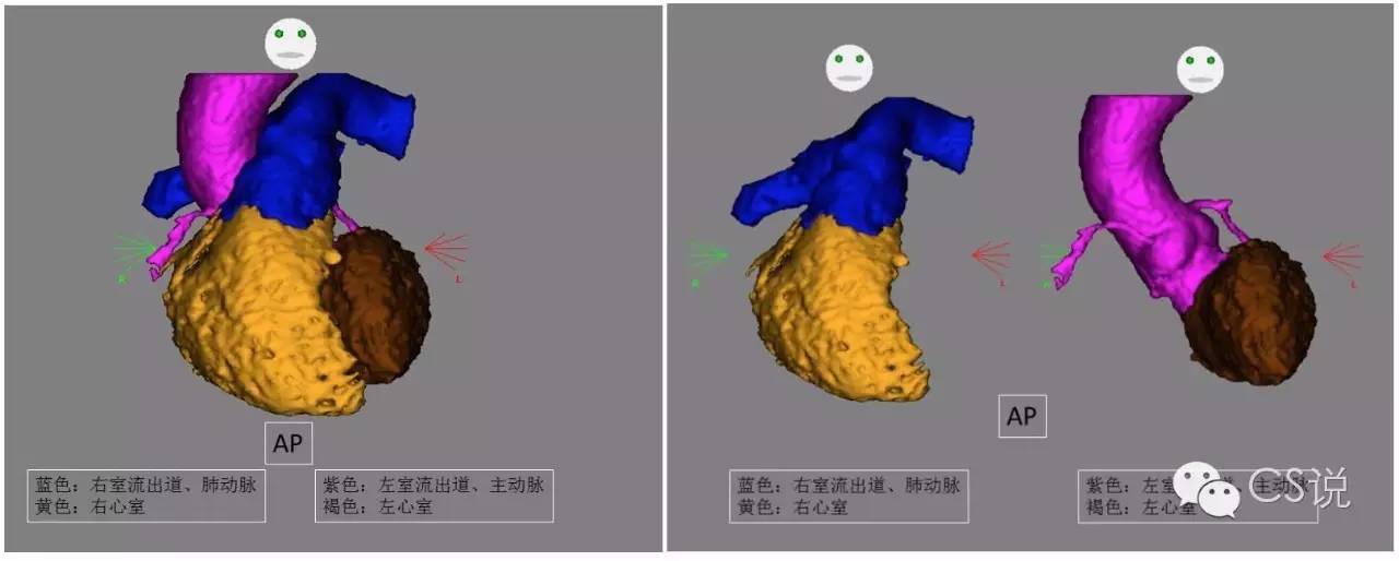 右室流出道室早定位总结(图文并茂)