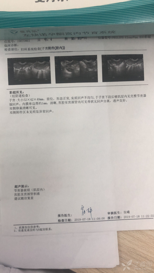 节育环下移伴肌层嵌顿可能 2019-07-18(入院当天)我院彩超:宫腔及宫颈