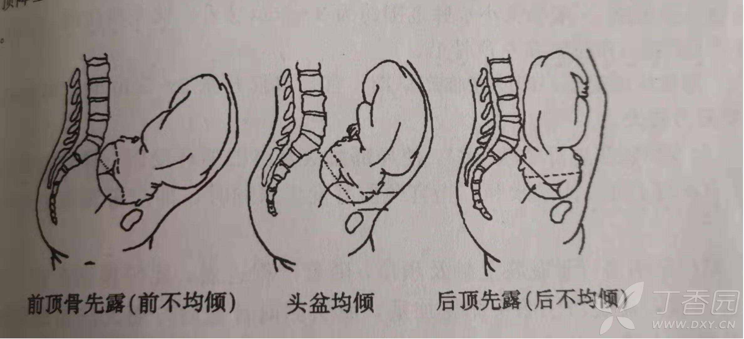 枕横位和前不均倾位