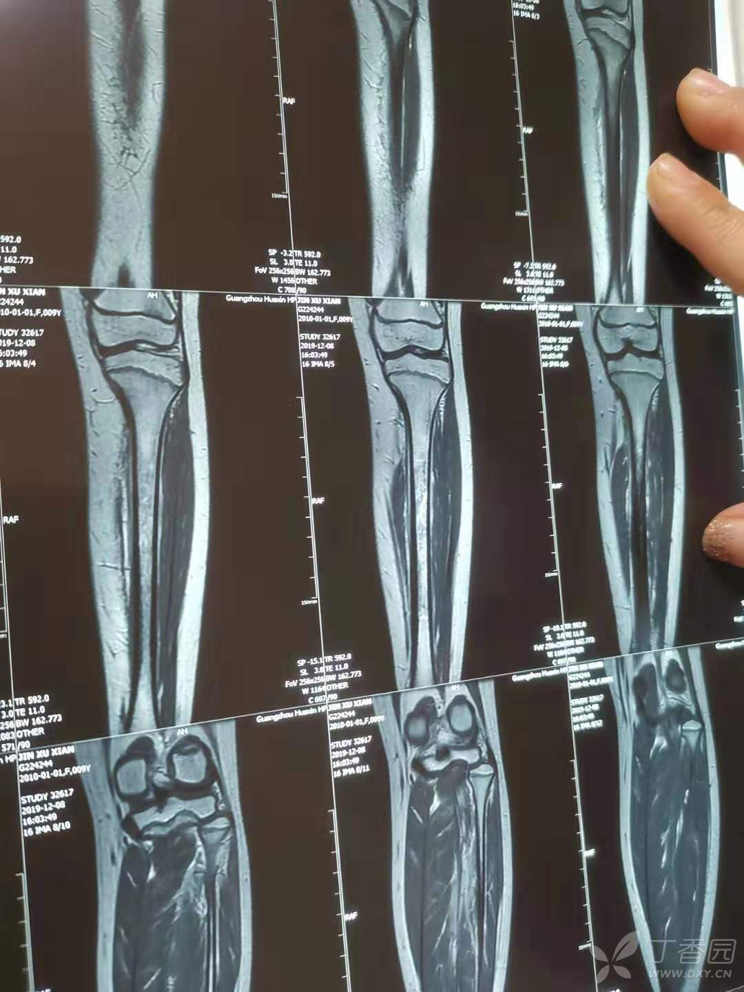 儿童胫骨骨肿瘤?