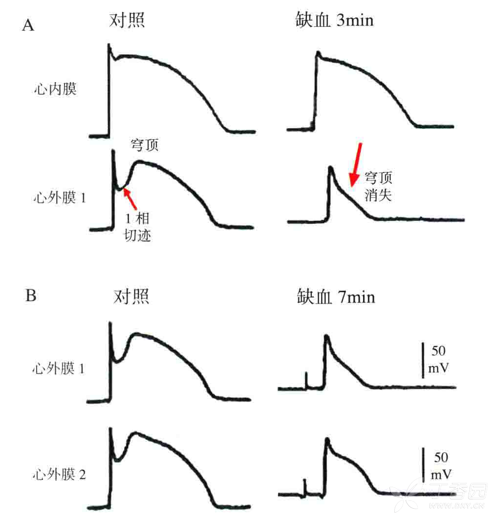 三分钟时,心内膜的动作电位无变化,心外膜心肌动作电位2项穹窿顶消失