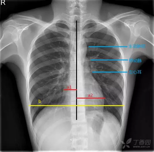 扒一扒 心内科医师需要警惕的那些异常胸片征象 心血管时间