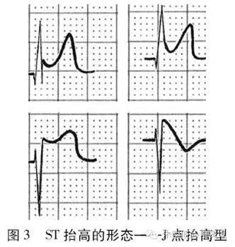 ① 诊断标准:J点后60～80ms处st段抬高≥0.10mV,右胸导联≥0.