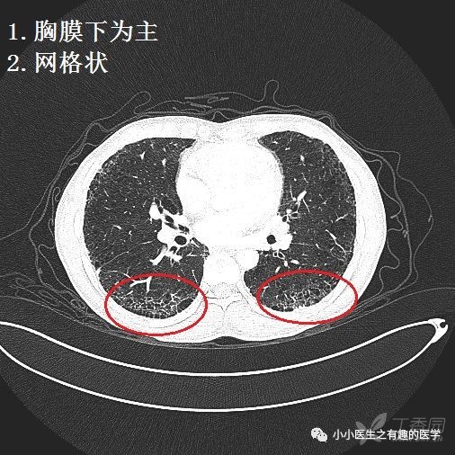 间质性肺炎的典型图谱,值得学习 影像核医学-丁香园论坛