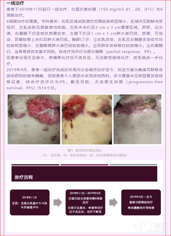 绝经后hr /her2-晚期乳腺癌一线维持治疗首选氟维司群