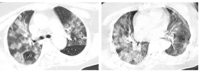 记住这首诗:快速了解新冠病毒肺炎影像改变(配病例图片)