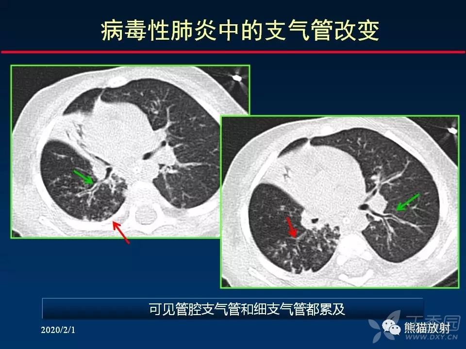 精准判读支气管感染的基本ct表现 [病例帖]