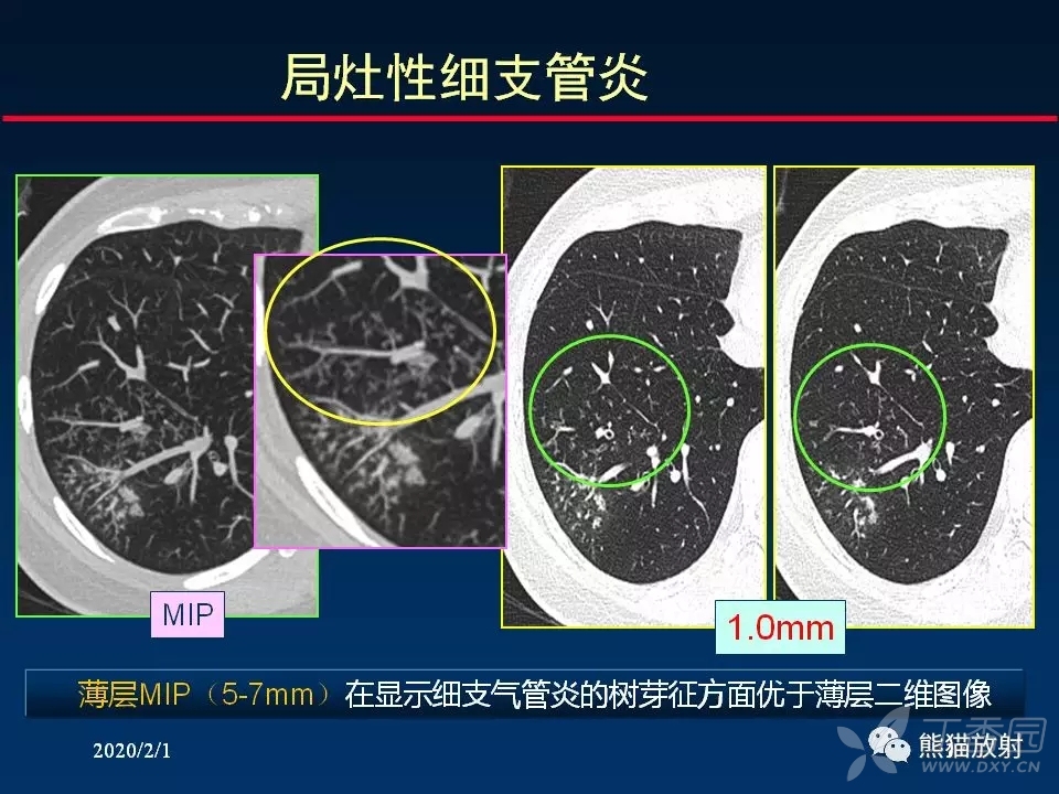 精准判读支气管感染的基本ct表现 [病例帖]