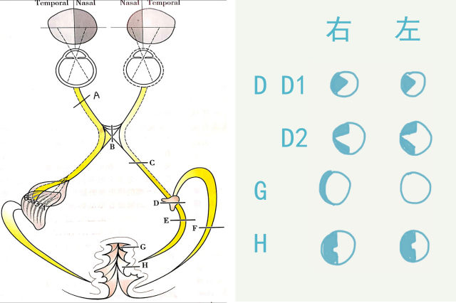 双眼颞侧盲:发生于视交叉处 (b); 双眼同向性偏盲:发生于视交叉之后