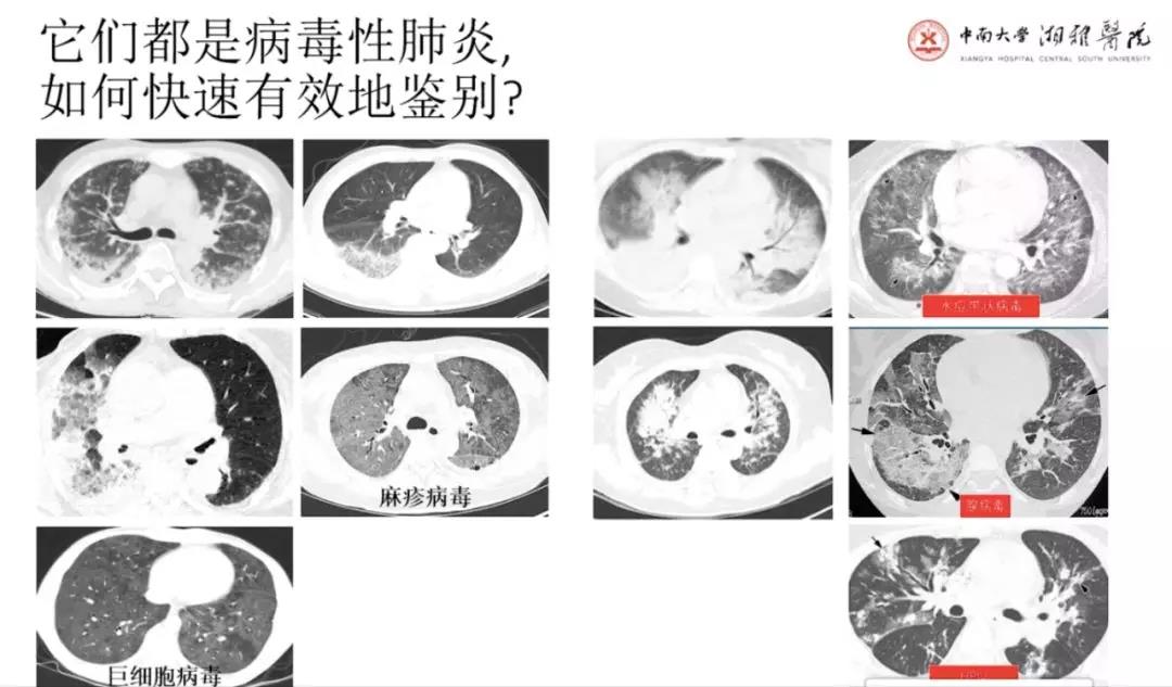 病毒性肺炎 ct 影像