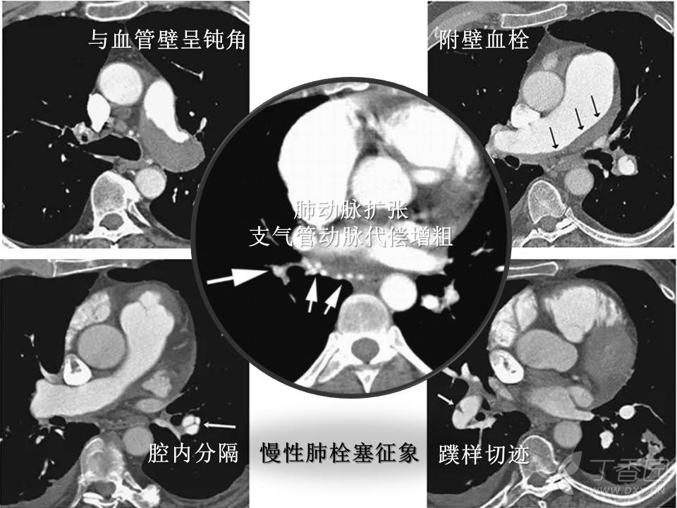 急性肺栓塞 ctpa 直接征象 - 影像医学和核医学讨论版