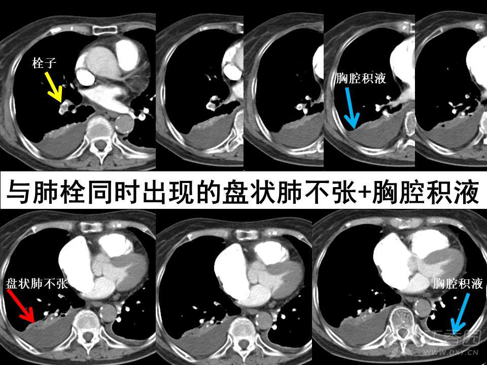 急性肺栓塞 ctpa 直接征象 - 影像医学和核医学讨论版