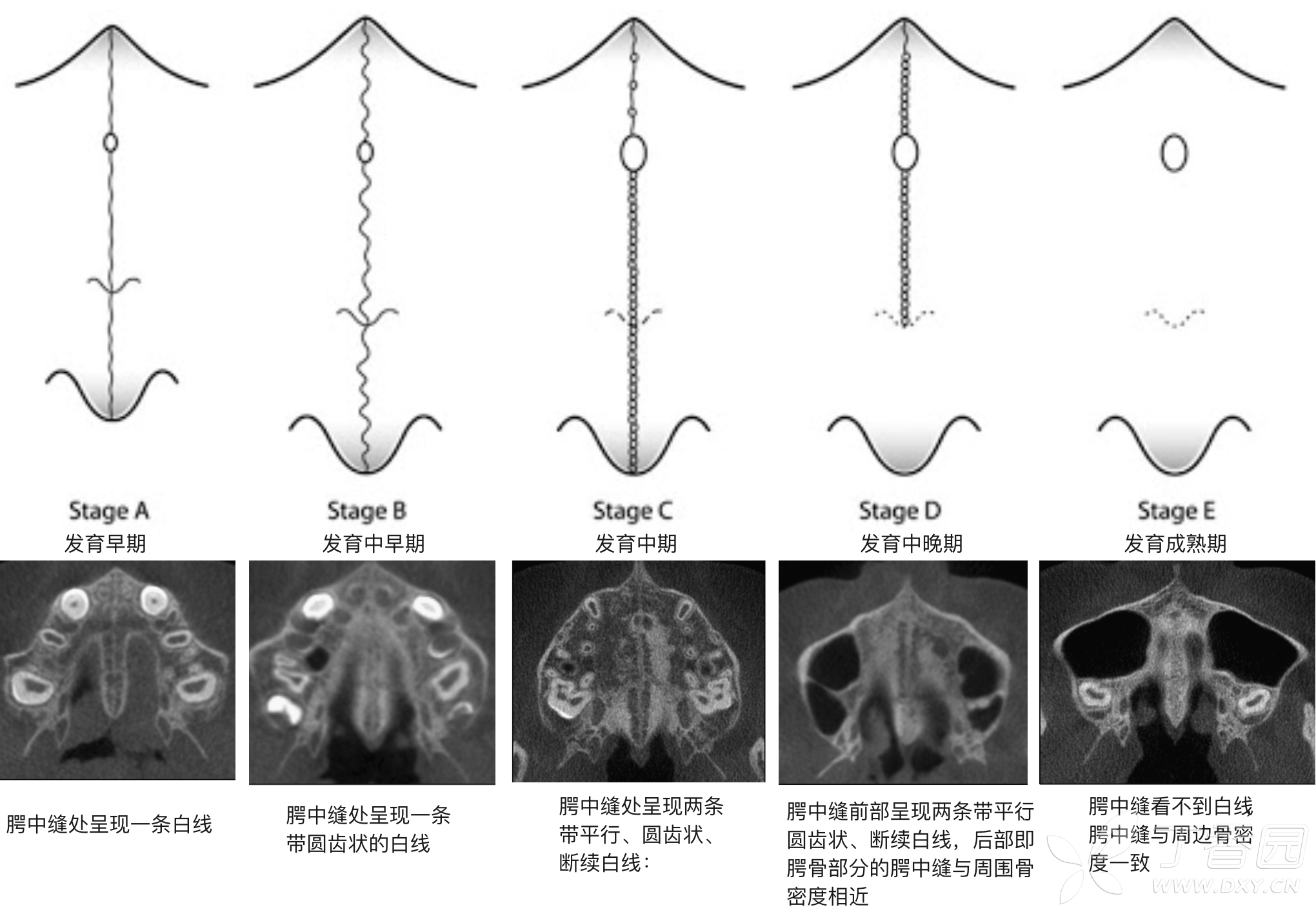 正畸临床病例(八"横向先行"扩弓的方法与技巧