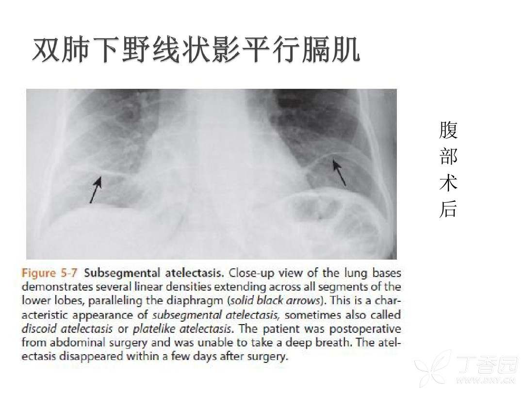 各位老师,这是盘状肺不张么?