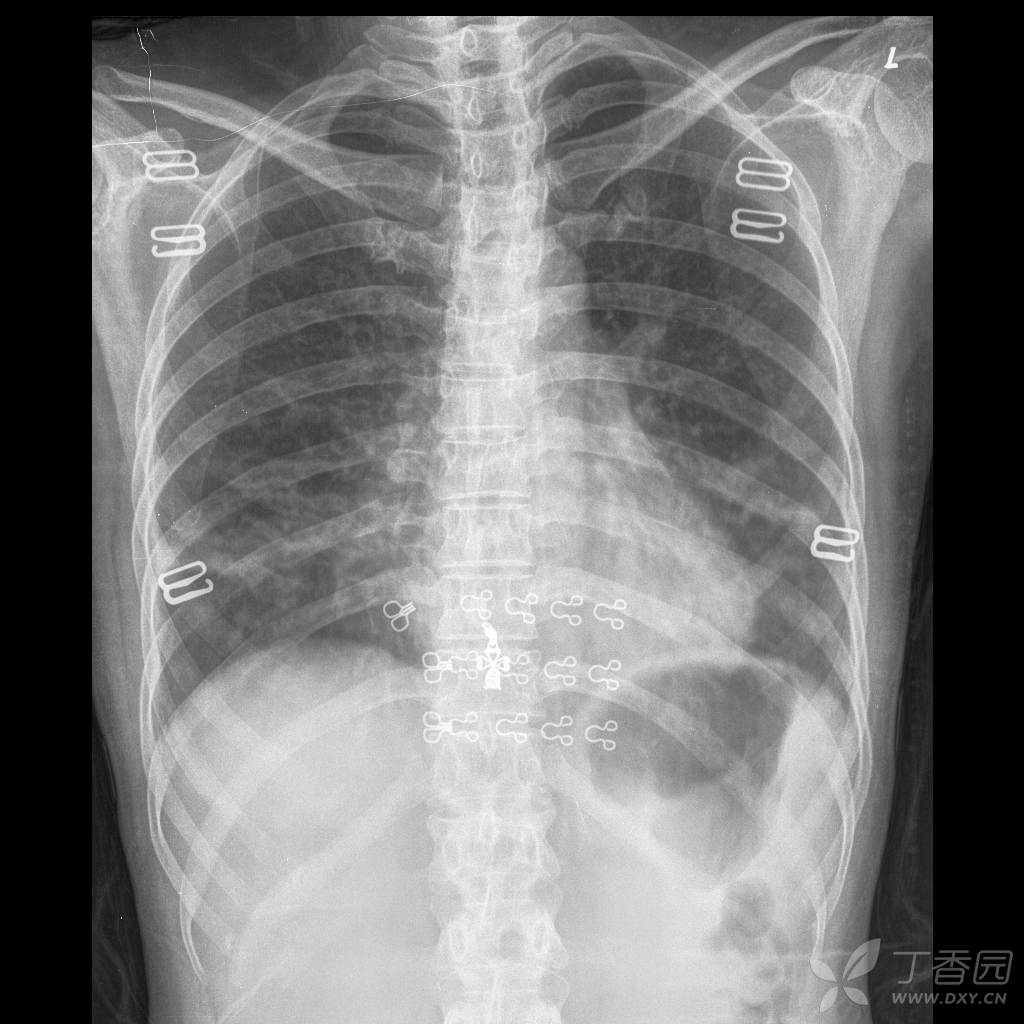 疫情期间,胸片,请老师看看