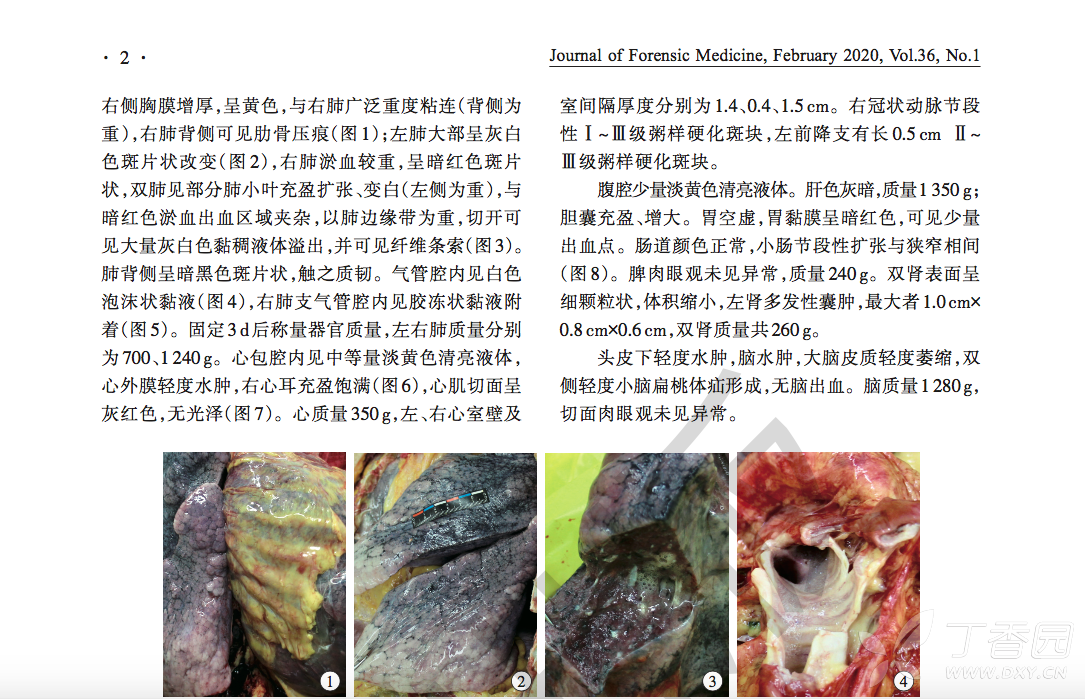 首例新冠肺炎逝者遗体解剖报告#:病变仍聚焦肺部,其他脏器损伤证据不