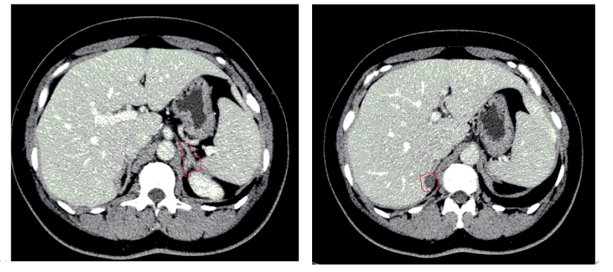 肾上腺 ct 阅片提示右侧可见小腺瘤,左侧可见增粗