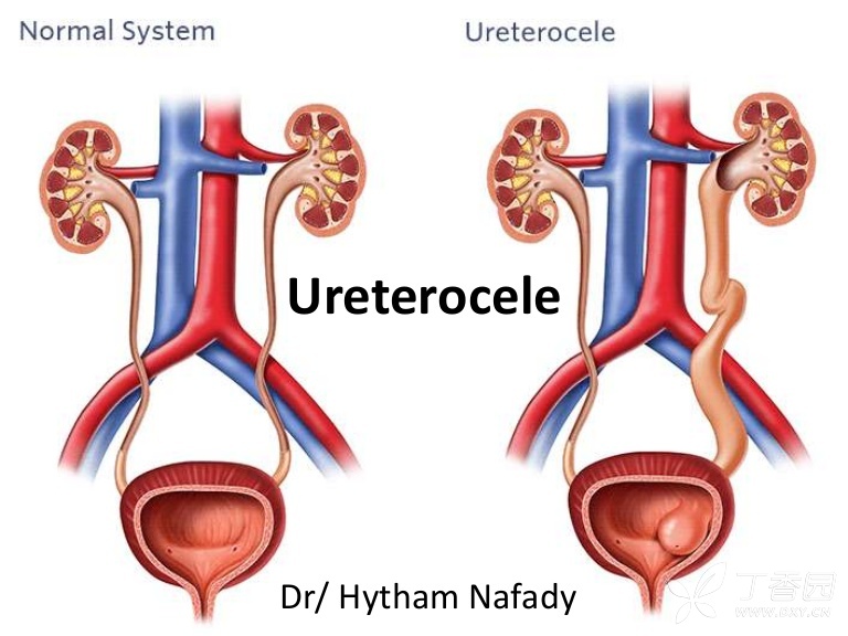 输尿管囊肿(ureterocele)