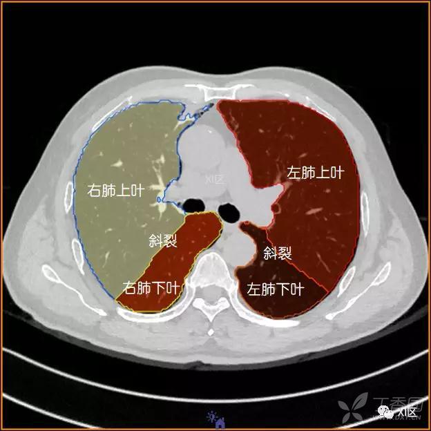 影像医学和核医学讨论版 腹盆  肺的分叶 左肺借斜裂成上,下两叶;右肺