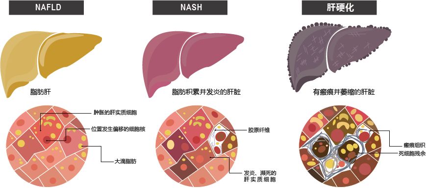 疾病状态,包括从肝脏脂肪变性到非酒精性脂肪性肝炎(non-alcoholic