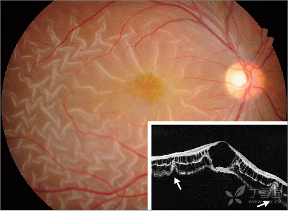 遗传性视网膜劈裂症[nejm]