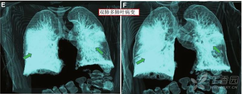 双肺3d重建能够有助于对新冠肺炎进行有效鉴别,提示双肺多肺叶病变.