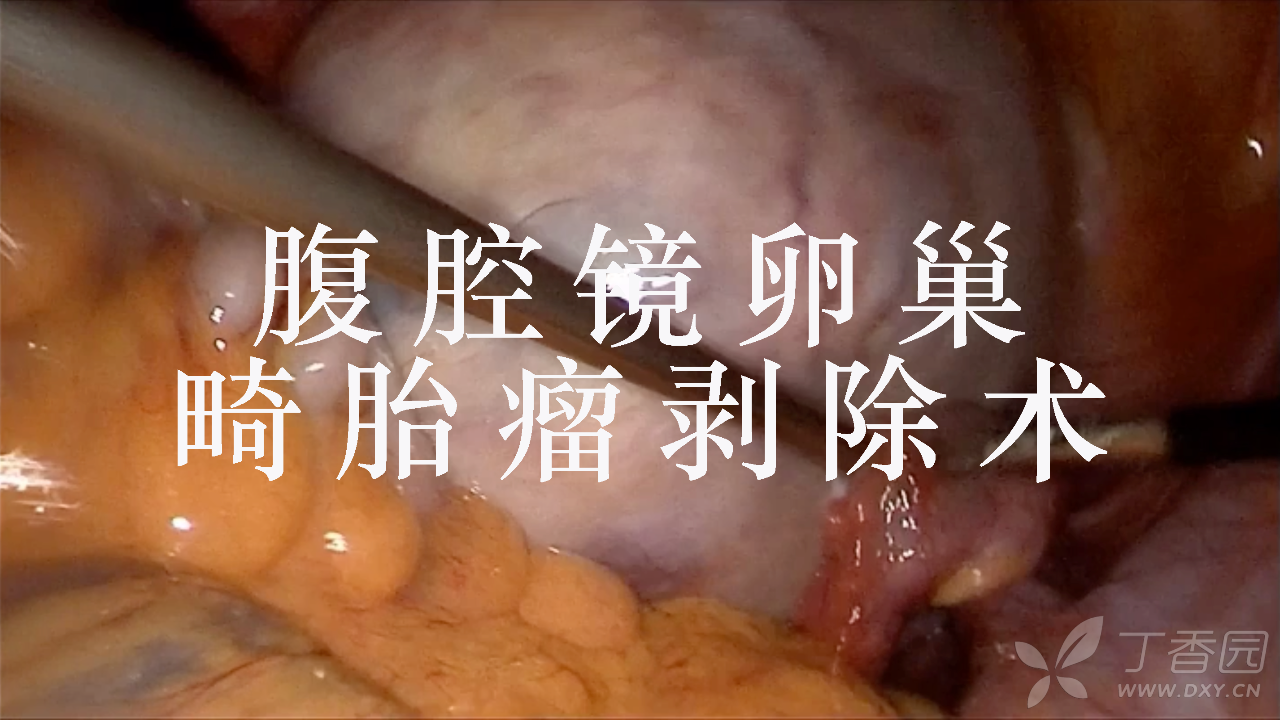 巨大卵巢畸胎瘤剥除术「高清手术视频」