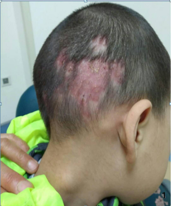 头癣 头癣指真菌感染头皮和头发所致疾病,常发生于青春期前儿童.