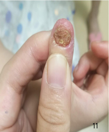一例   岁女童,右手拇指末端指节皮肤潮红肿胀,脱屑,指甲变黄,甲板变