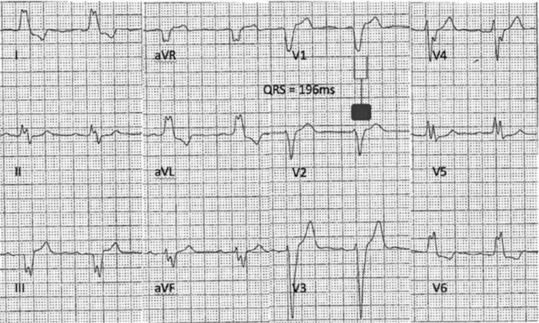 患者心电图呈窦性心律,完全性左束支传导阻滞,qrs 波宽度 196 ms