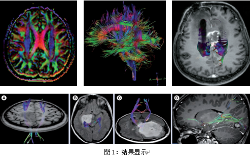 脑肿瘤术前mri弥散张量成像评估及其临床意义