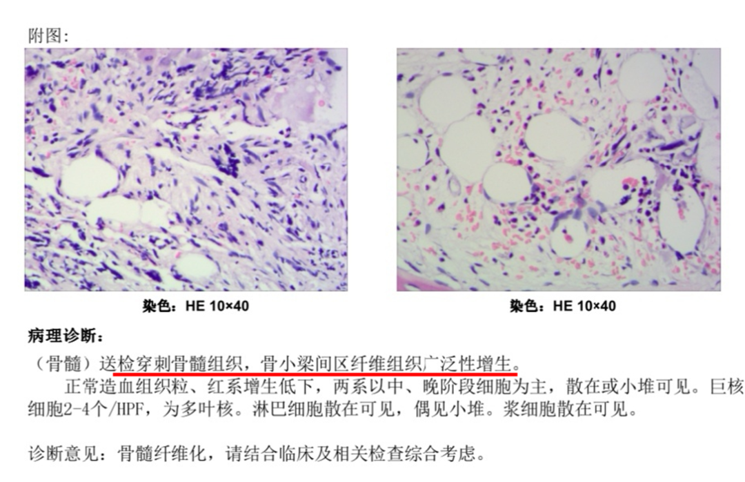 第三期芦可替尼治疗骨髓纤维化一例