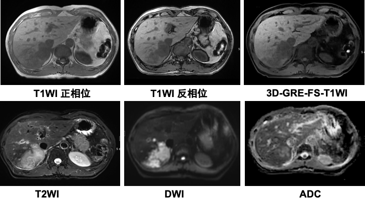 如下肝内占位的病例, 腹部 mri 不同序列和病灶大家都认出来了吗?