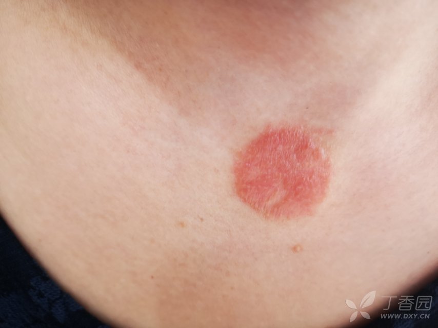 患者胸前,后背环状红斑丘疹伴瘙痒,反复发作1年