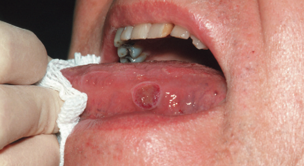6)舌癌最容易生长的部位是舌头两侧缘,但是舌头上的口腔溃疡没有固定