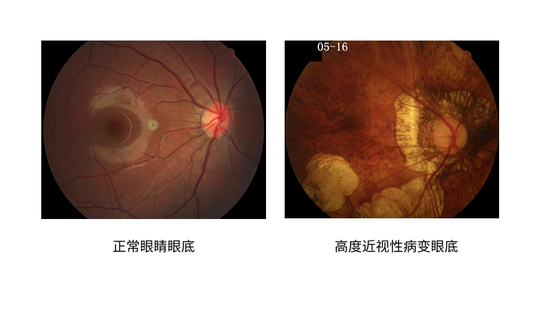 高度近视的你,查眼底了吗?